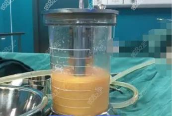 昌乐360度水动力吸脂费用多少钱？