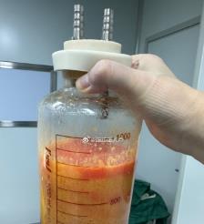 昌乐水动力吸脂手术要做多久？